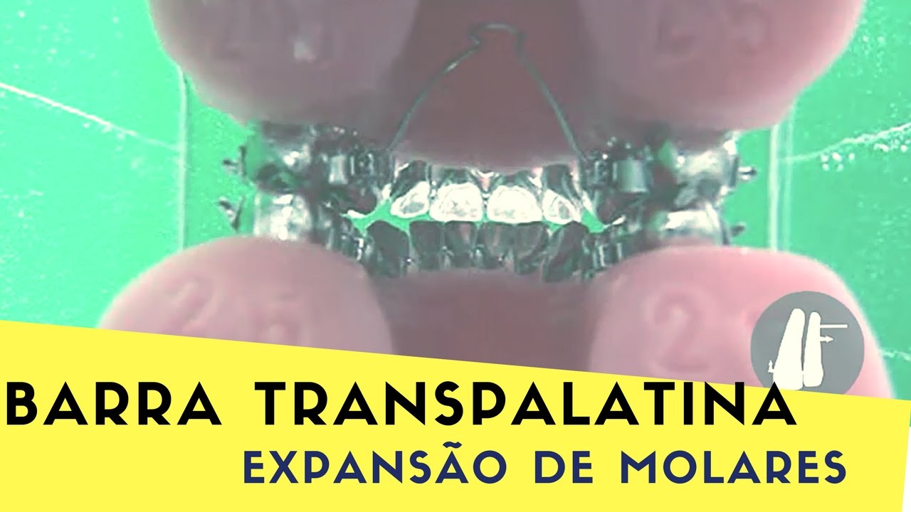 EXPANSÃO DE MOLARES POR INCLINAÇÃO