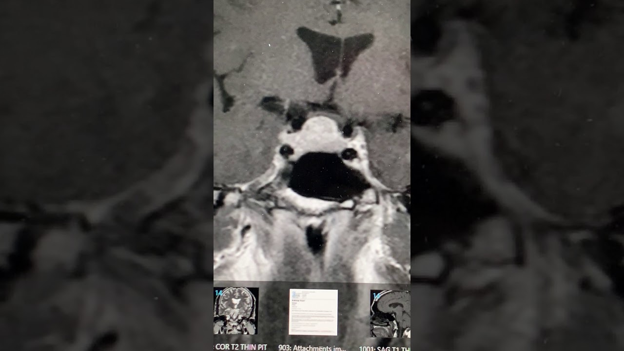 A radiology study of a pituitary macro adenoma