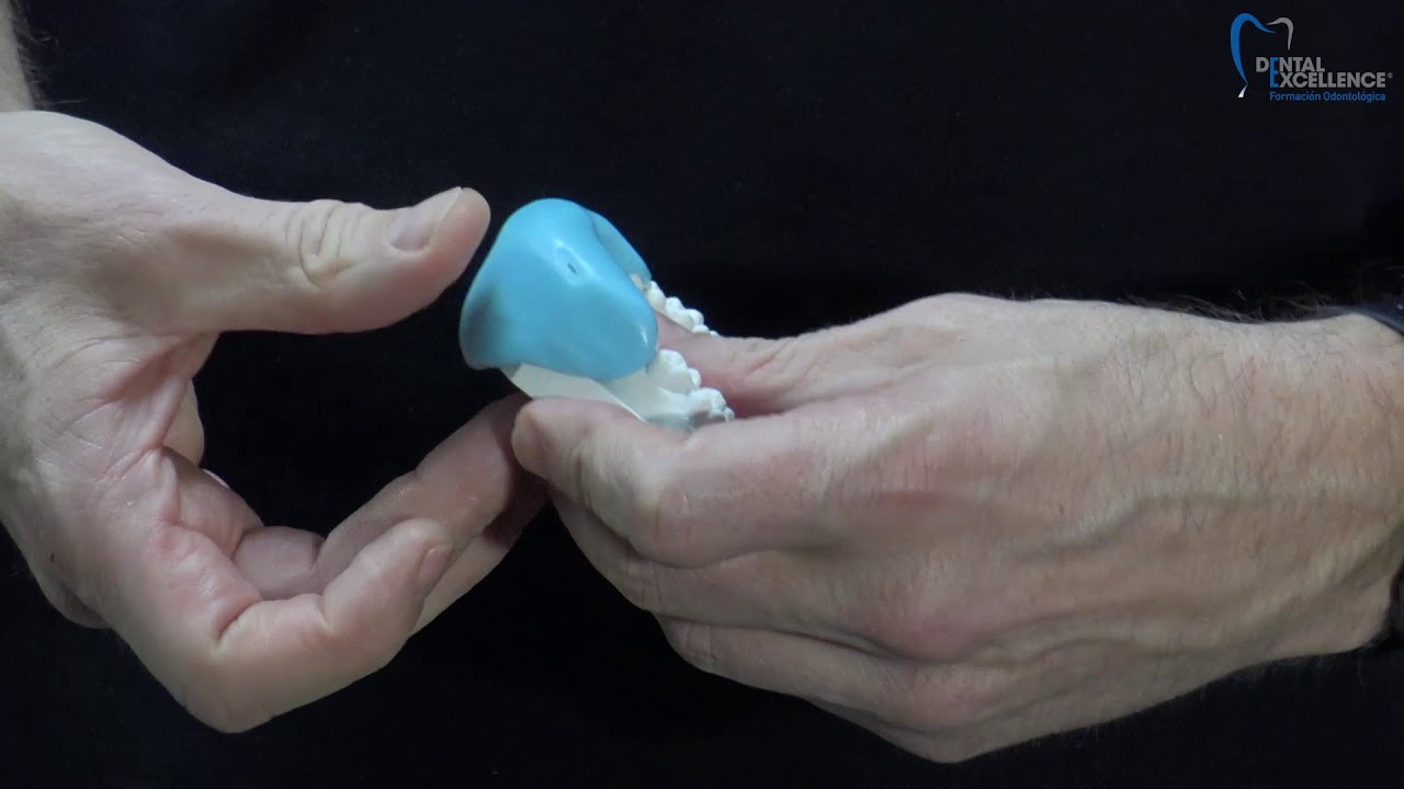 Dental Mock-up. The Key is the key