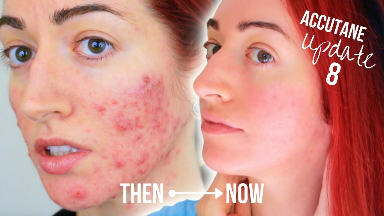 My Accutane Update (8 Months!) With Before & After | Jess Bunty