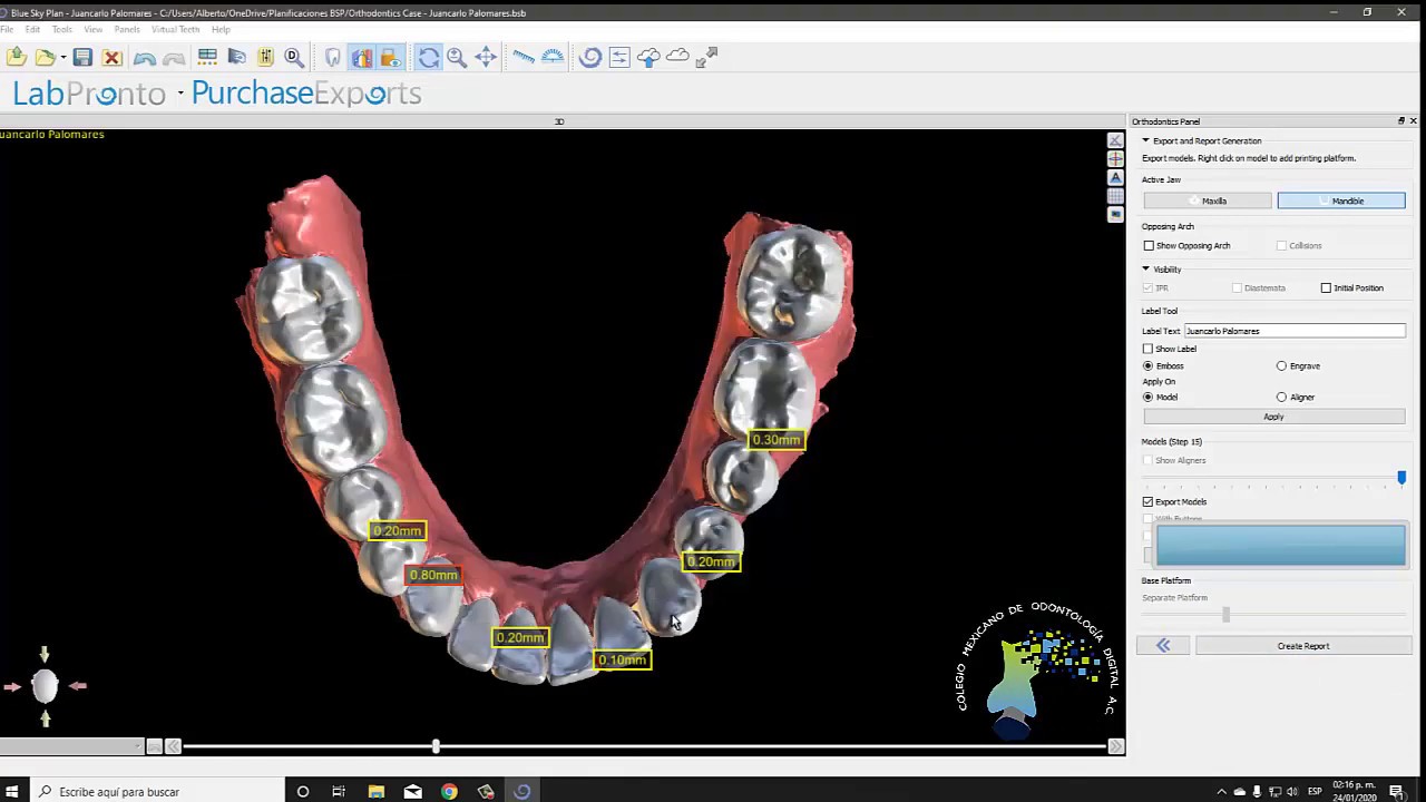 Diseño de alineadores Invisibles con Bluesky Plan Ver  4.7.15
