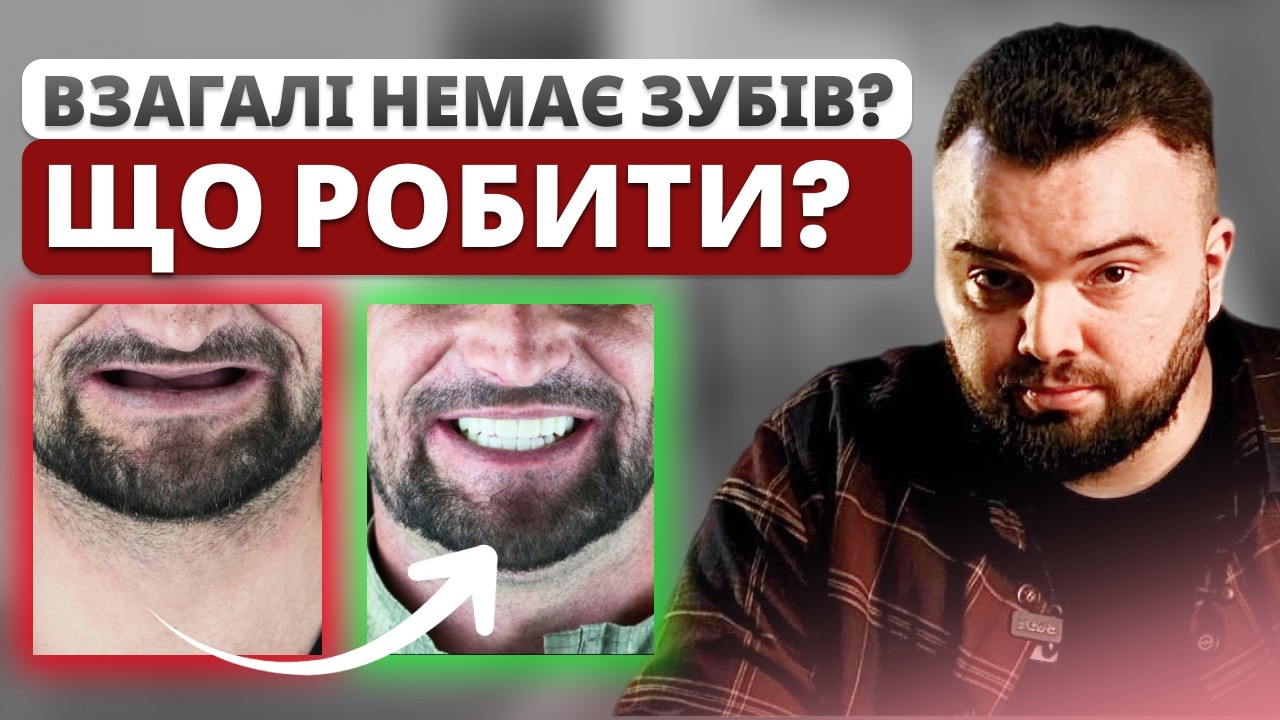 Повна реабілітація зубів за 1 тиждень: як проходить All-on-4 у пацієнтів
