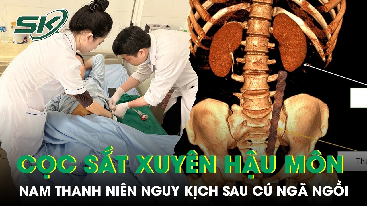 Nam thanh niên bị cọc sắt xuyên qua hậu môn sau cú ngã ngồi | SKĐS