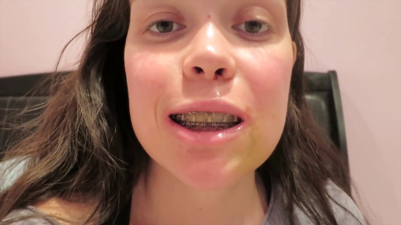 DOUBLE JAW SURGERY | Day 4