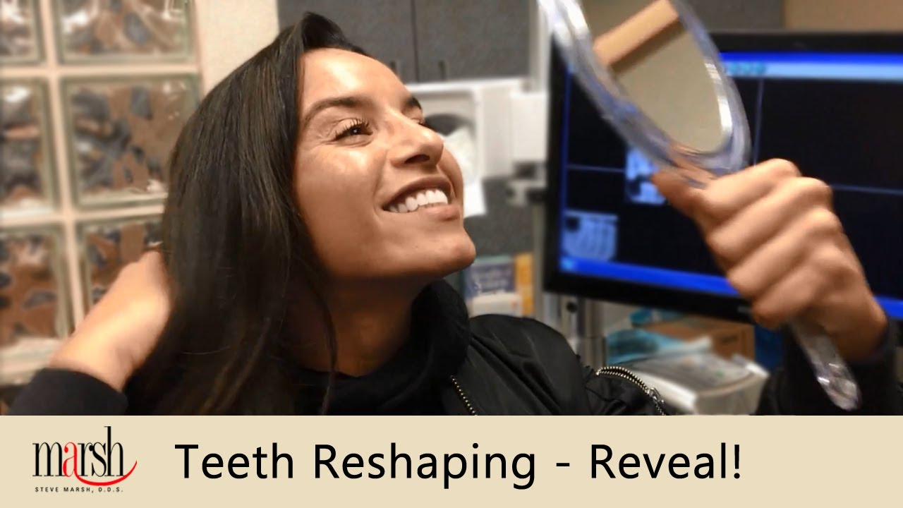 Teeth Reshaping & Contouring | Smile Reveal | Dr. Steve Marsh Cleveland Dentist