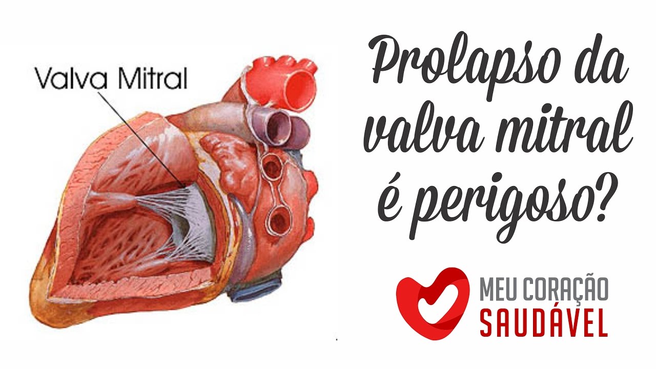 Tenho Prolapso da Valva Mitral. Devo me preocupar?