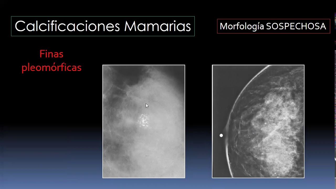 Calcificaciones Mamarias Parte II