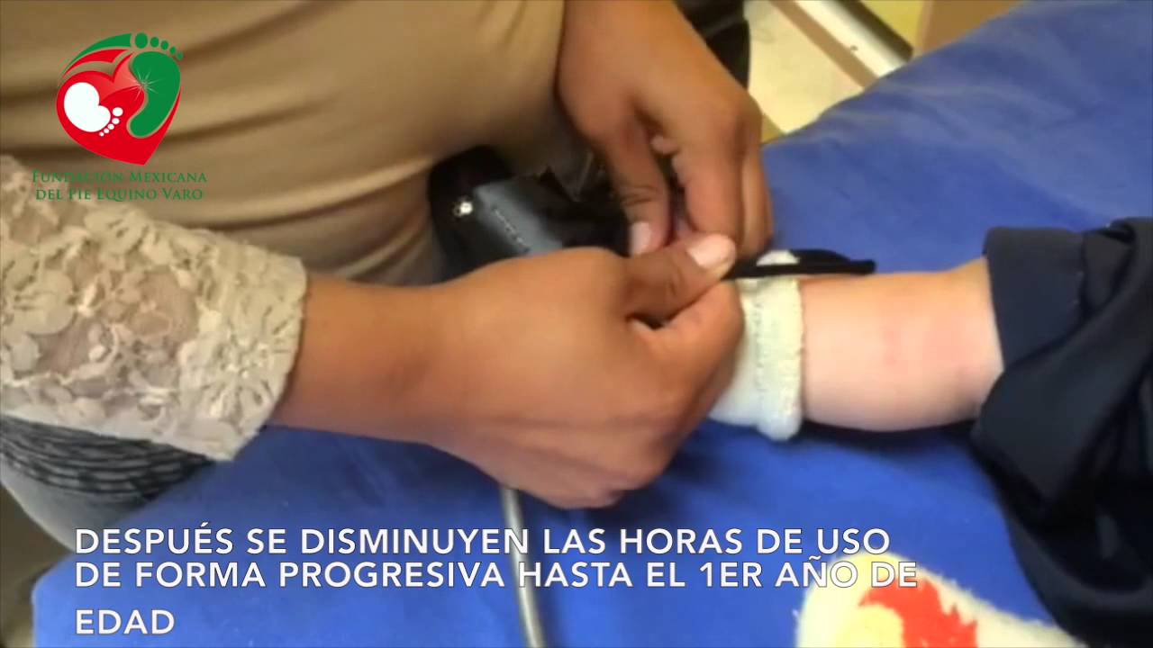 Colocación de la férula de abducción Steenbeek para pie equino varo