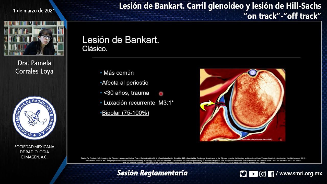 Sesión Reglamentaria:Lesión de Bankart.Carril glenoideo y lesión de Hill-Sachs  