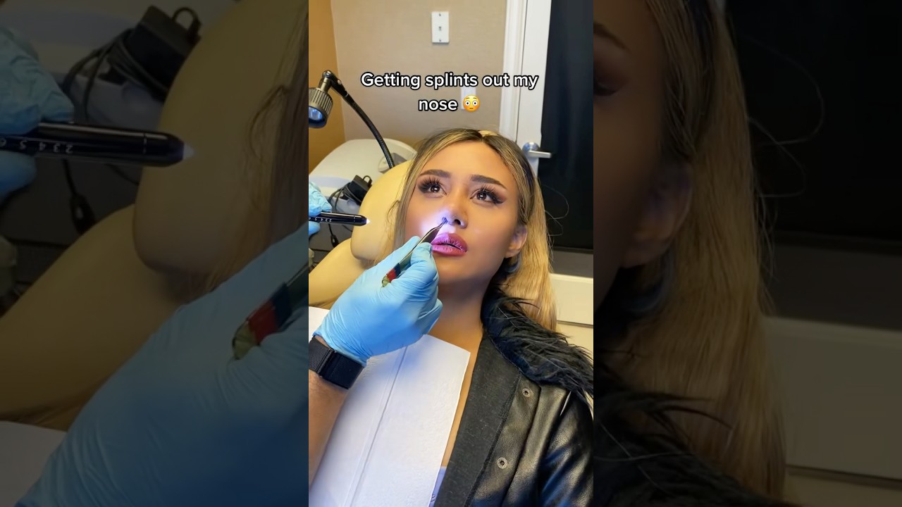 Getting my nose job splints out😳 gross but funny throwback😂 #cosmetic #nose #crazy