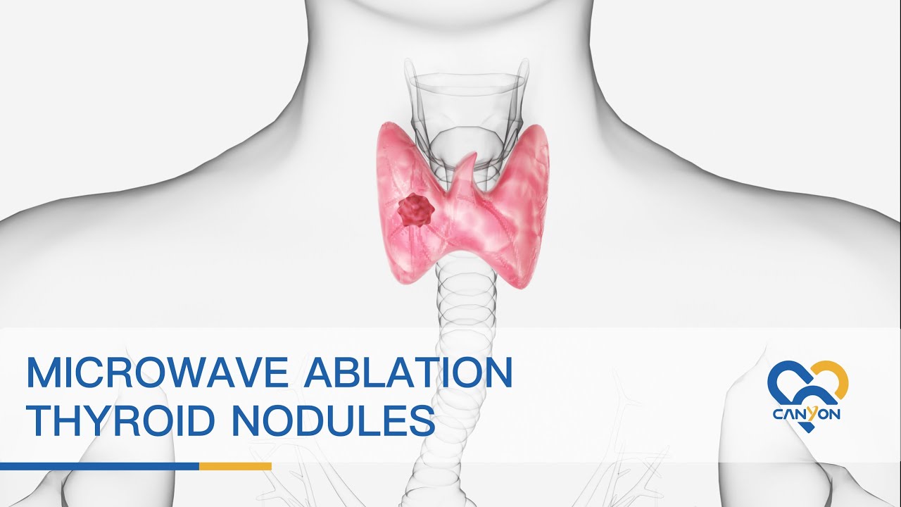 Microwave Ablation of Thyroid Nodules - Animation