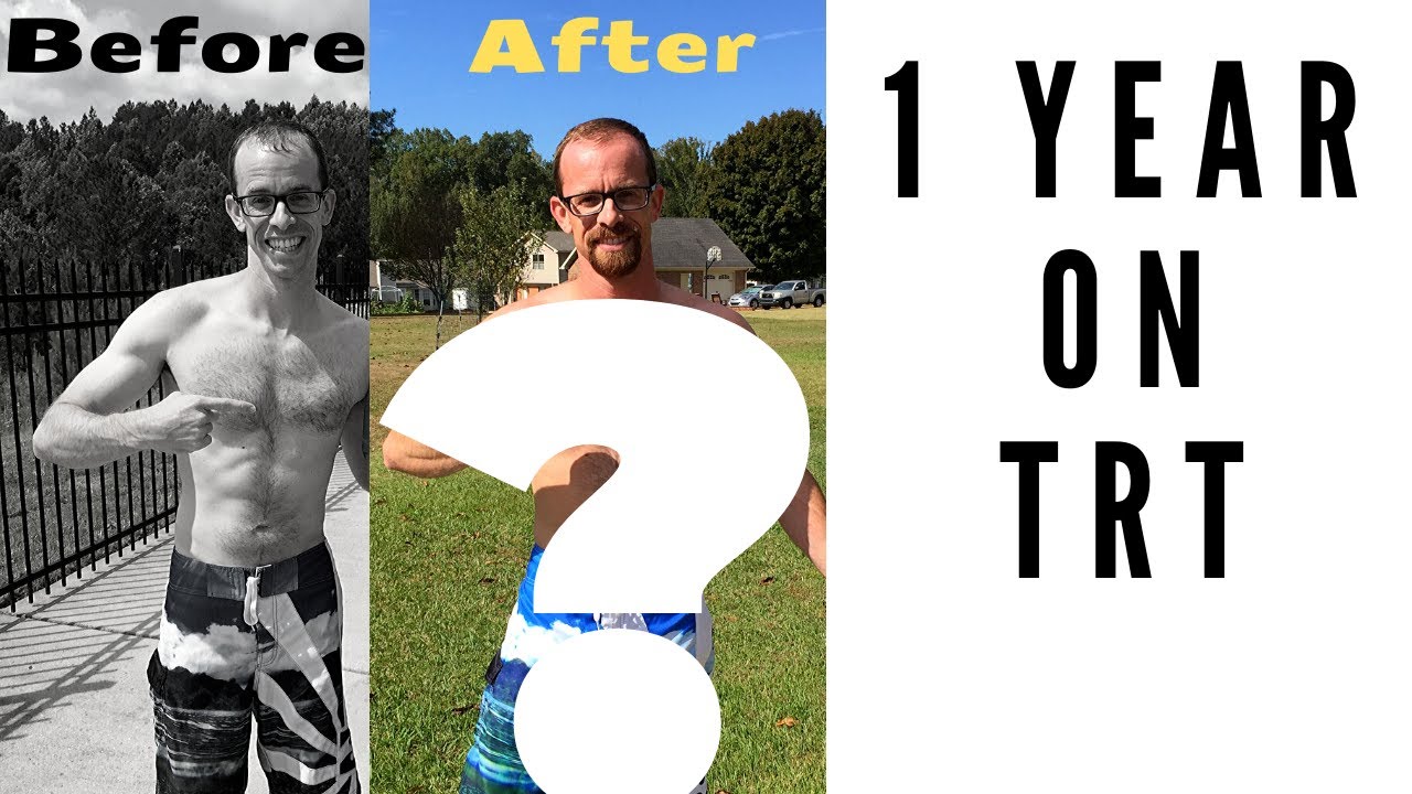 One Year On TRT (Testosterone Replacement Therapy)