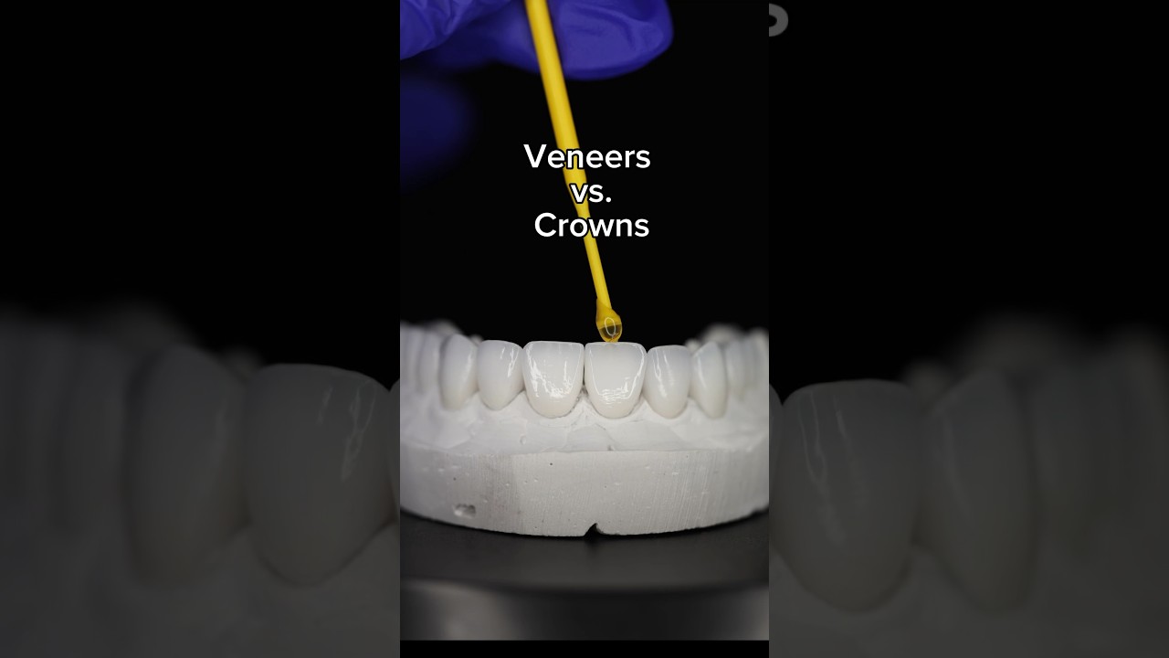 Veneers vs. Crowns 🦷 Which is better for you?🤔 #veneersvscrowns #veneers #crown #dentalcrowns