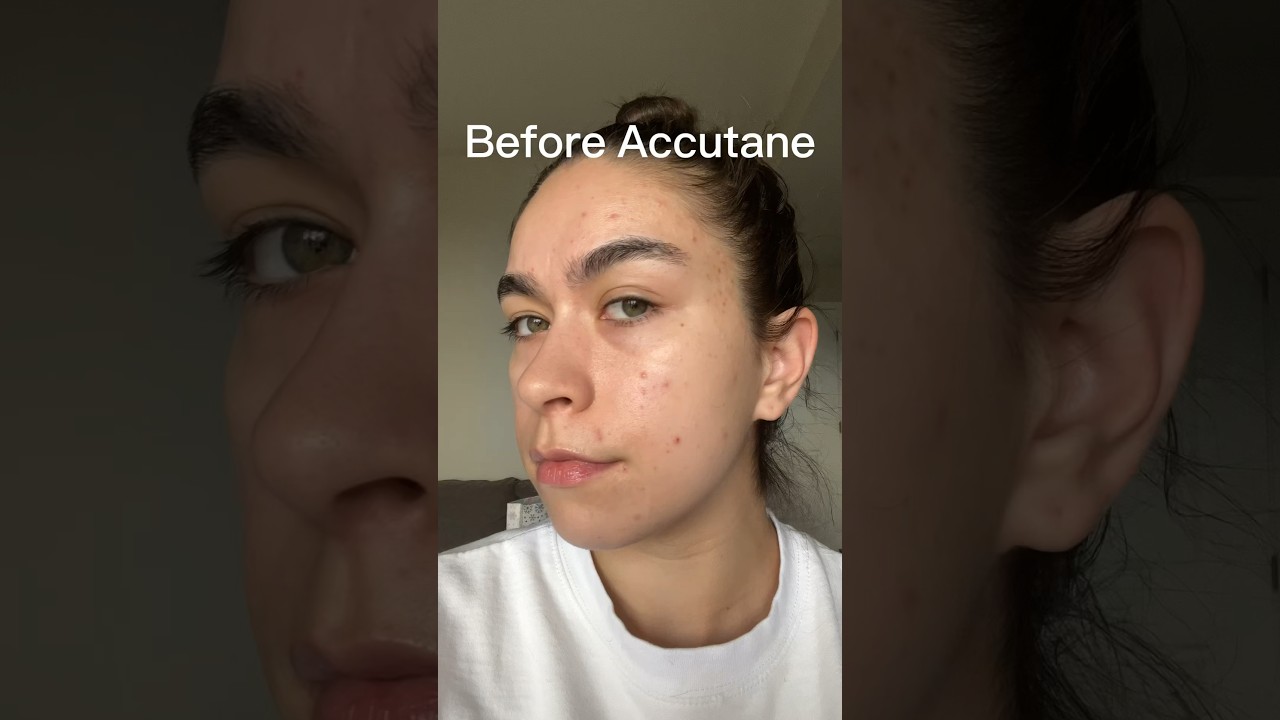 Before and after 8 months on Accutane!!!