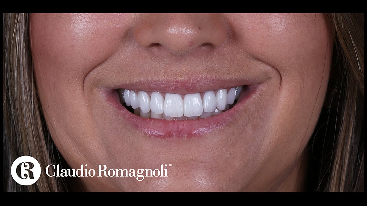 Casos Clínicos: Substituição de Restaurações de Resina Antigas | Dr. Claudio Romagnoli