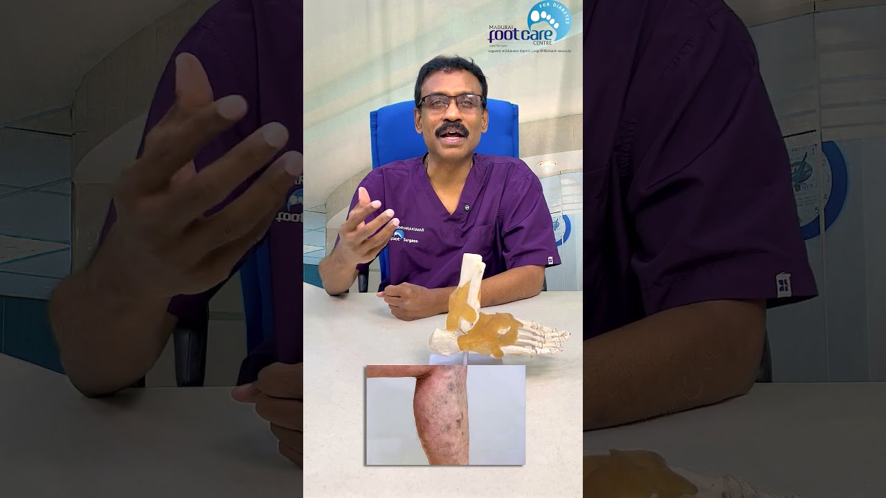 எத்தனை சிகிச்சை எடுத்தாலும் ஆறாத புண் இருக்கிறதா?  Foot Ulcer Won't Heal? What You Need to Know!
