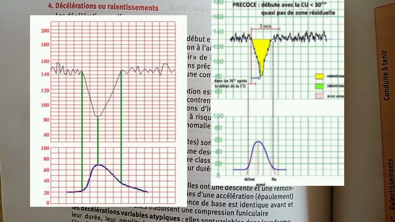 Soins obstétricaux: Interprétation de l'ERCF (L2_sagefemme)