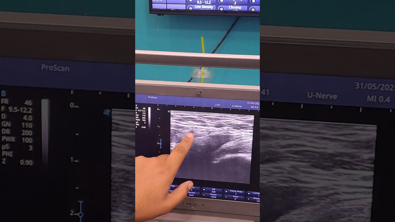 Ultrasound guided Genitofemoral nerve block
