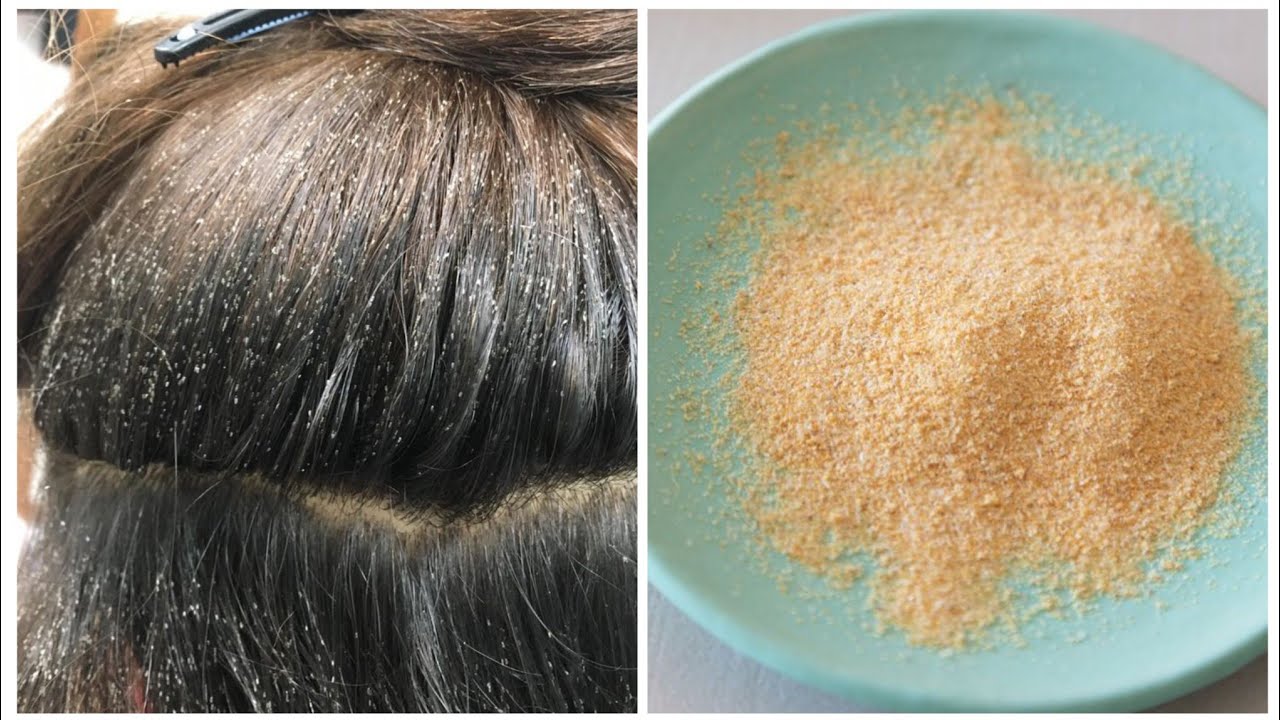Injirta 2 shay bes😱removing lice in 3 day 2 ingredients