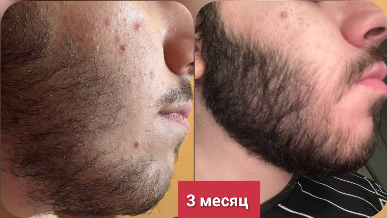 Как легко заставит бороду расти. Редкая борода в прошлом. Выпуск 92 Андрей Борода 