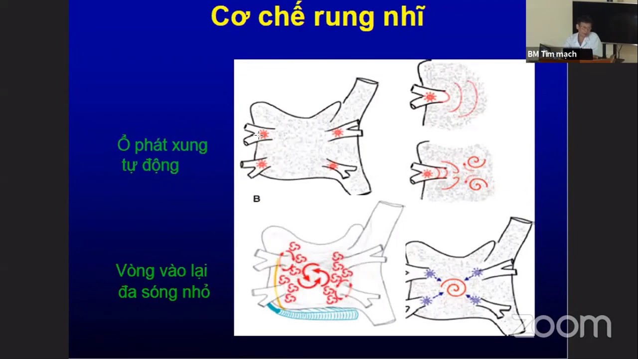 RUNG NHĨ: Cập nhật chẩn đoán và điều trị [Tim mạch 17/25]