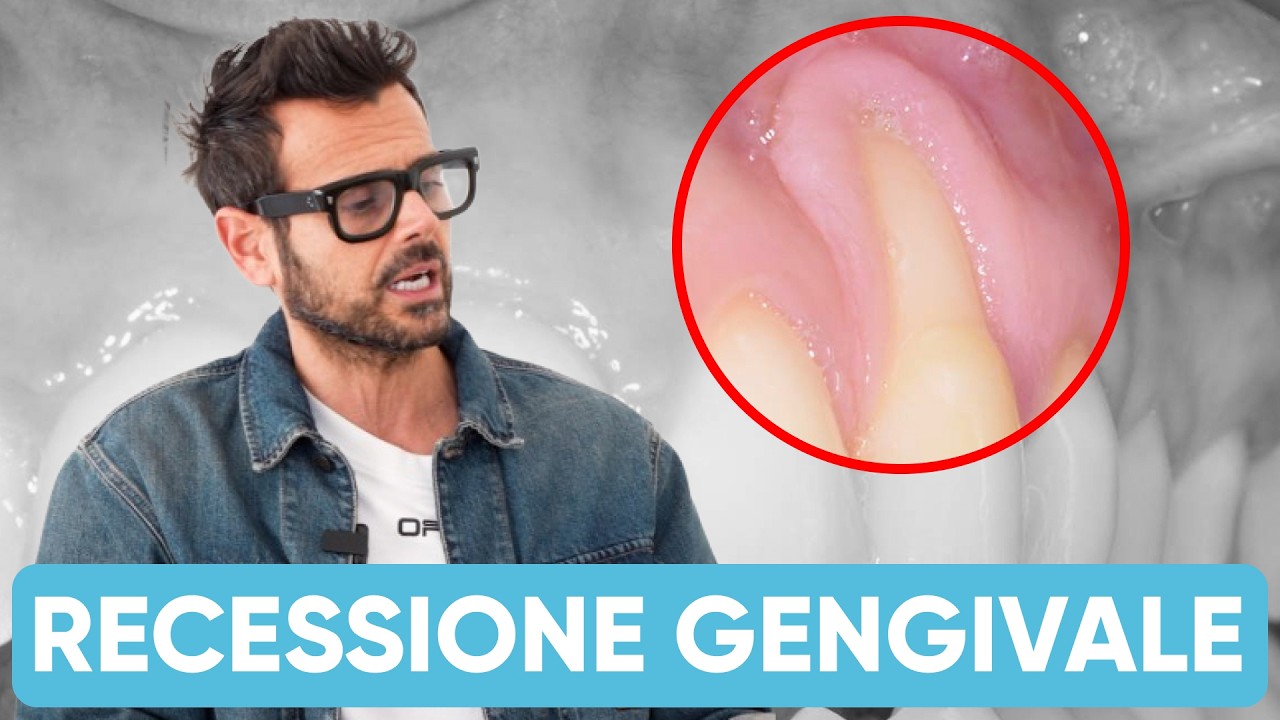 Recessione gengivale GRAVE: si può davvero salvare il dente?