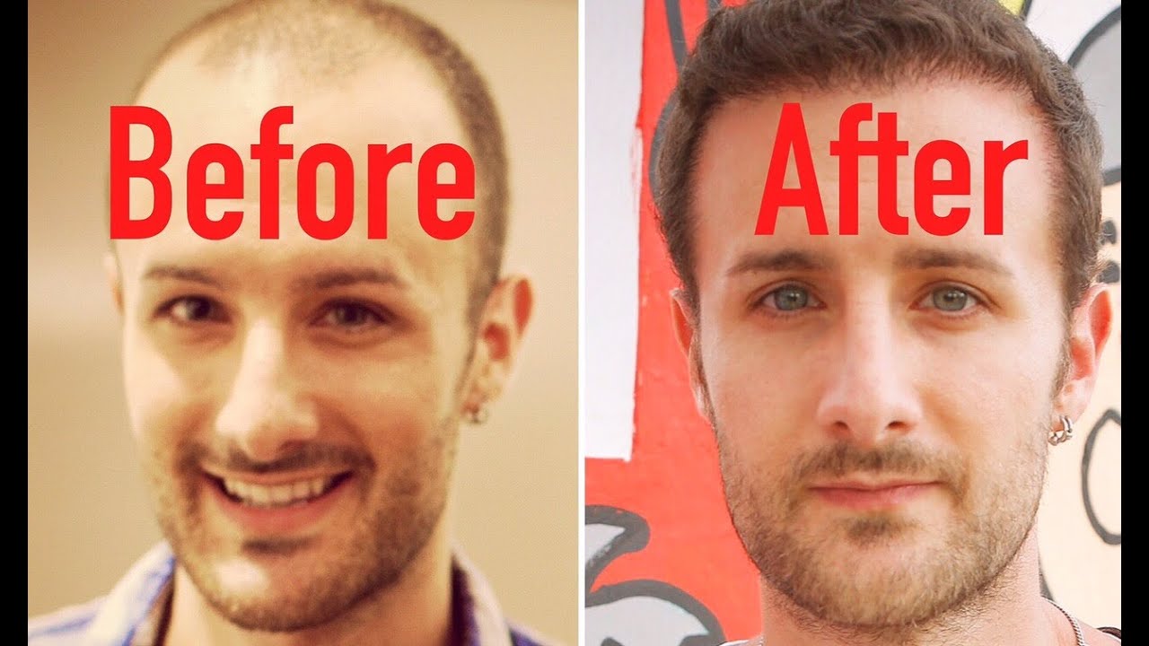 FUE Robotic Hair Transplant vs. FUE Surgery (By Hand)