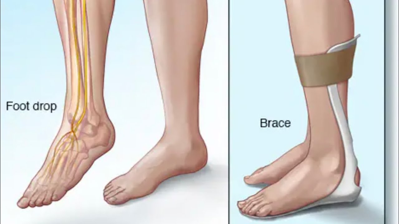 FOOT PROBLEM, FOOT DROP or FOOT DEFORMITY  IN A PATIENT