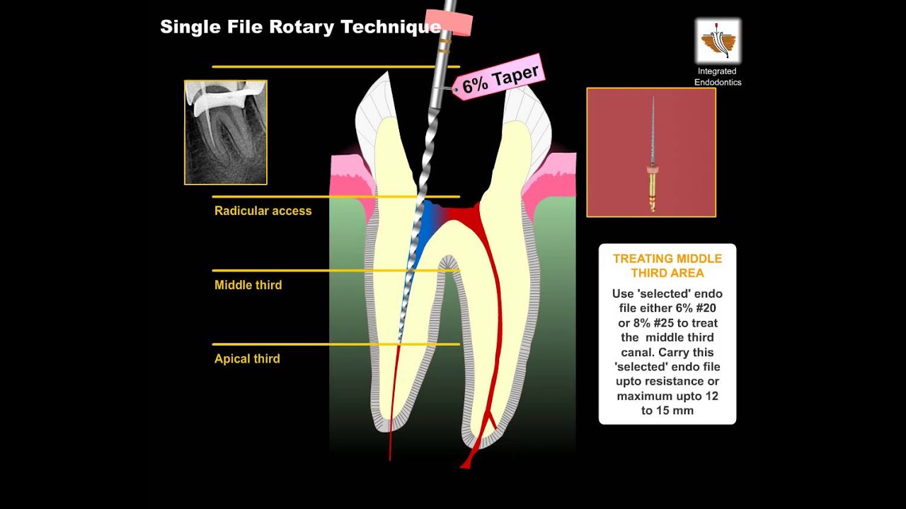 Single File Rotary Technique
