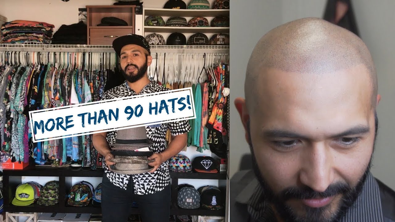 ♕ Alex BEATS hair loss w/ Hairline Ink, says NO MORE HATS! ♕