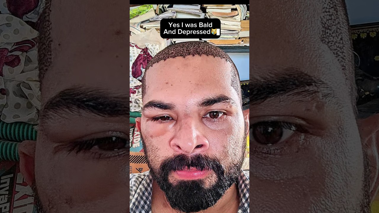 My Hair Transplant Results 99524 19890💥💥💥#ameerht #hairtransplant #hairlosstreatment