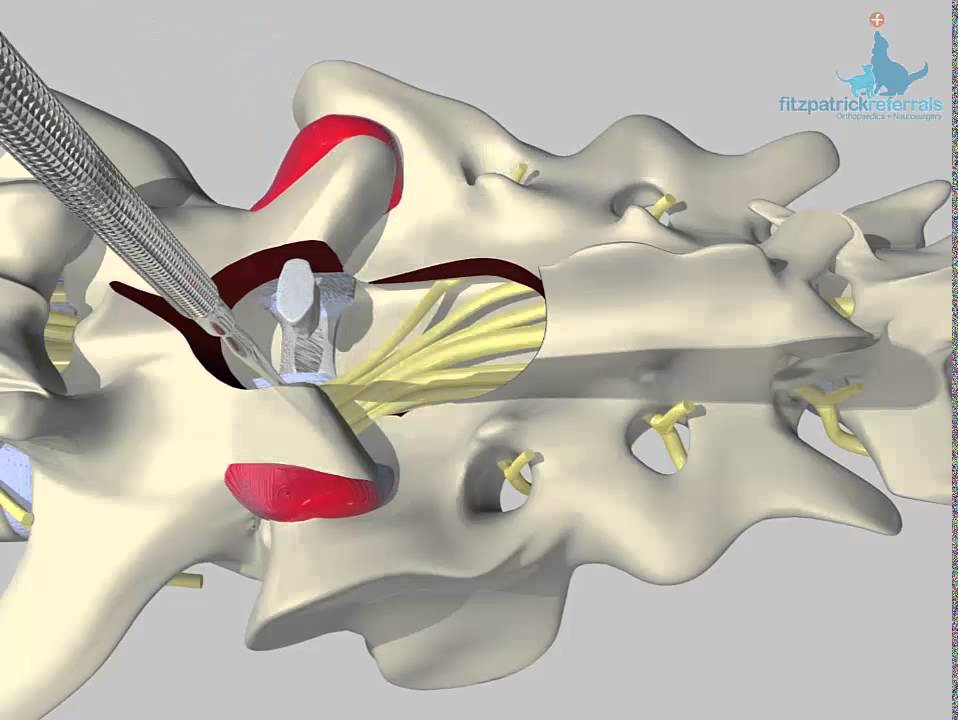 Dorsal view of lumbosacral distraction stabilisation surgical technique