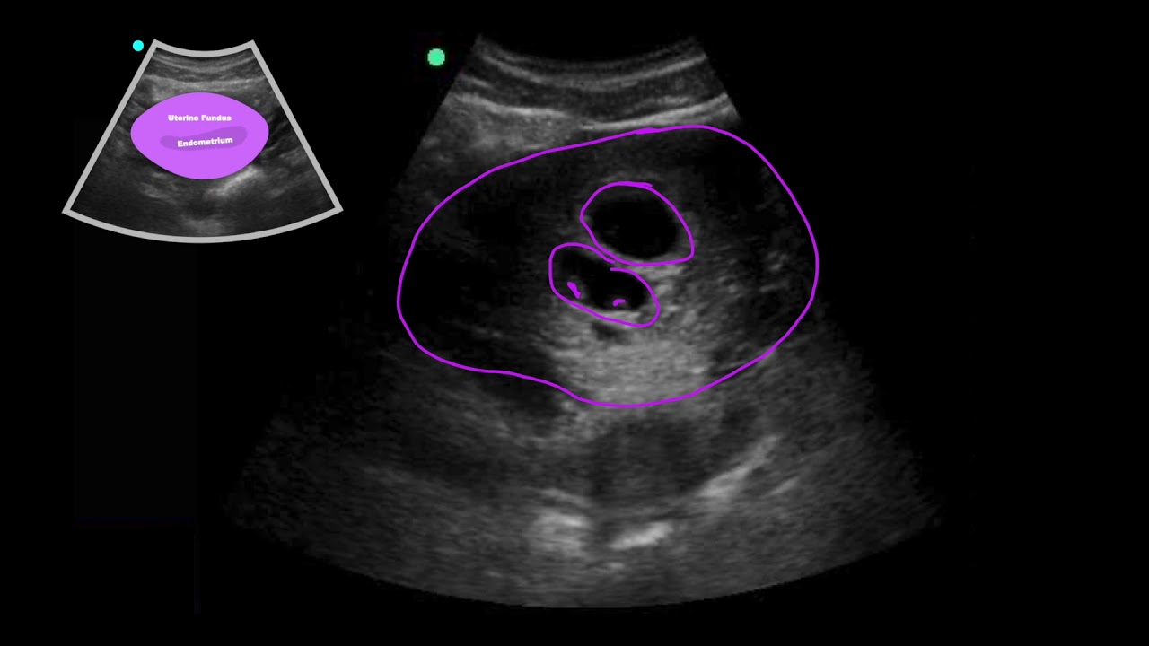 POCUS: 1st Trimester Pregnancy Case 3 - Twin Gestation 6w5d