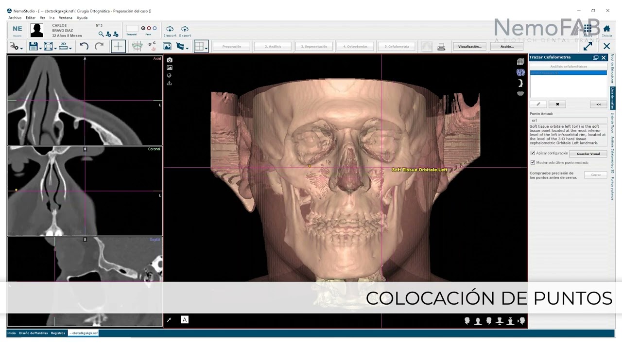 Demo NemoFAB - Software líder en cirugía ortognática_Español