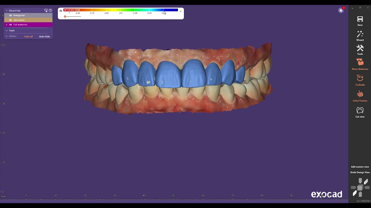Exocad Mockup Design on Tooth 4 to 4
