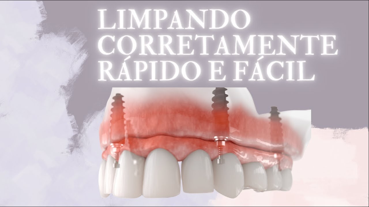 COMO LIMPAR PR&Oacute;TESE PROTOCOLO SOBRE IMPLANTES (PR&Oacute;TESE FIXA)