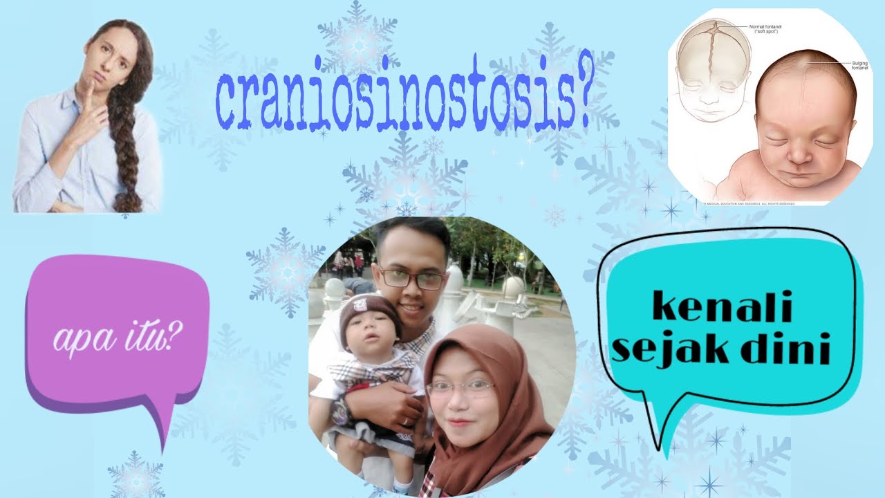 Apa itu craniosynostosis? Berbagi kisah merawat anak istimewa