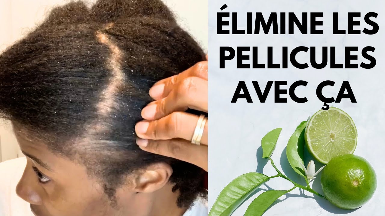 Remède naturel efficace pour traiter les pellicules du cuir chevelu #cheveuxsecs #demangeaisons