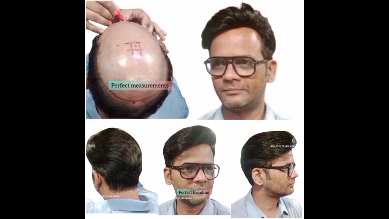Without surgery hair replacement near you 