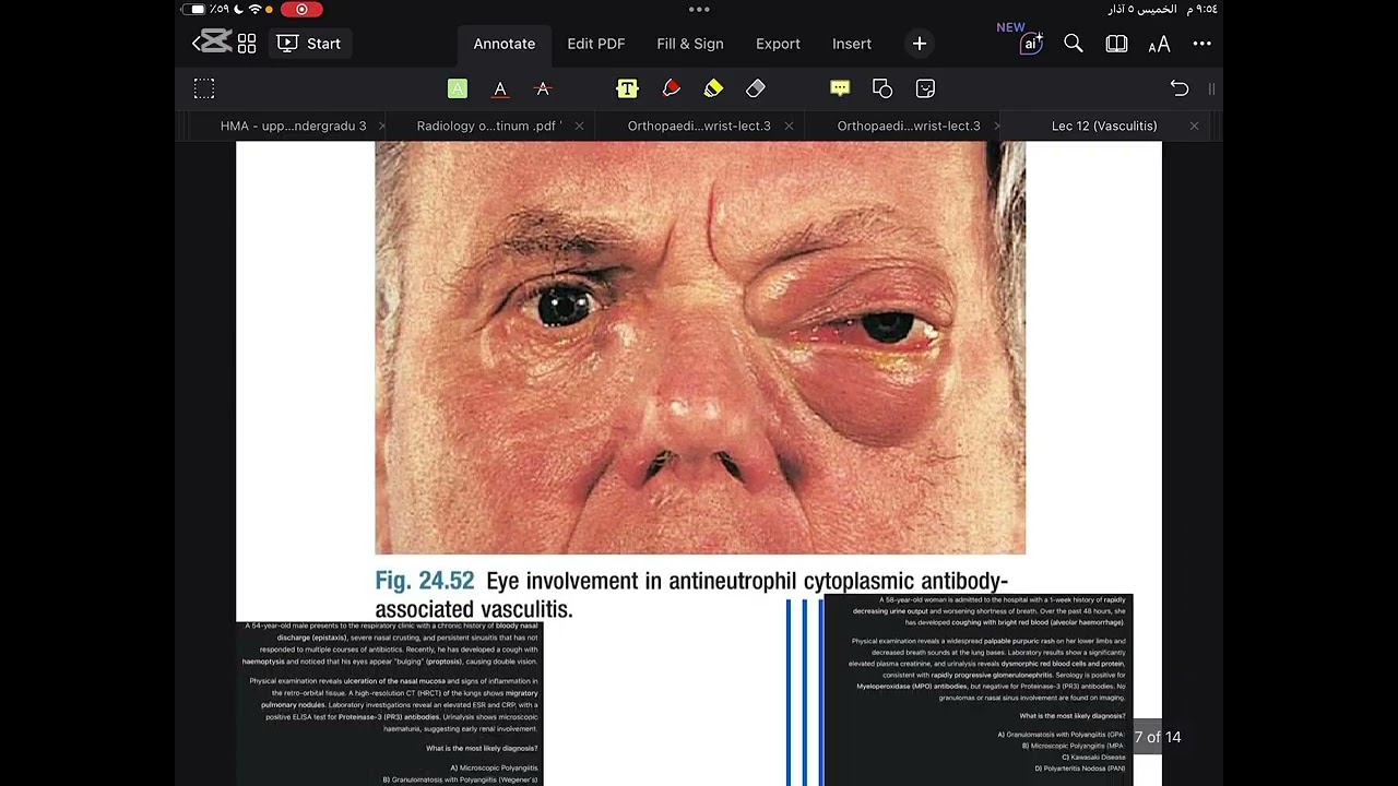 Rheumatology || Vasculitis [ part 2 ] 