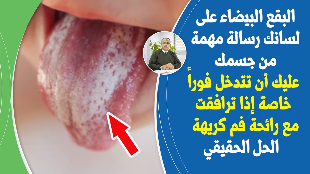 إذارأيت بقع بيضاء أوتلون في اللسان وشممت رائحة فم كريهة فهي علامة ضرورية تتطلب حل هذه المشكلة الصحية