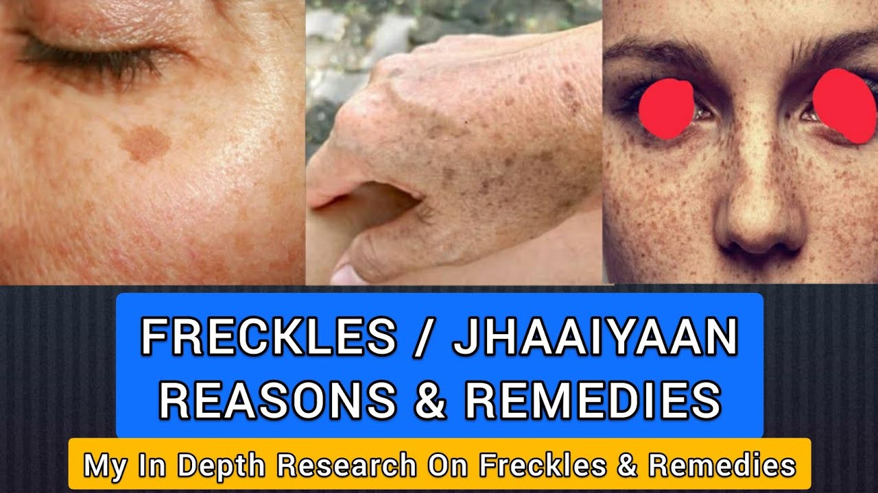 Freckles / ज्ञाइयां - What, Why, Types, Home remedies, Other Treatments | With English Subtitles