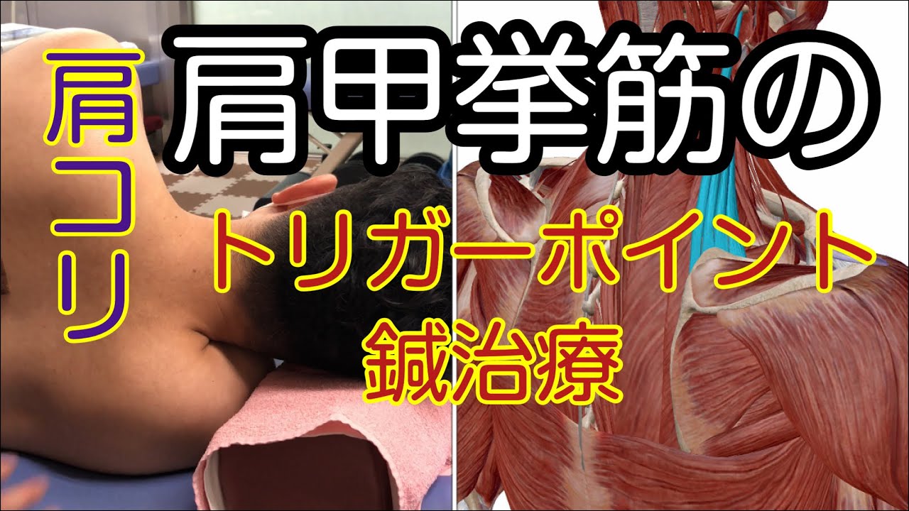 肩甲挙筋のトリガーポイント鍼治療、肩こり、首が短く見える姿勢、trigger point