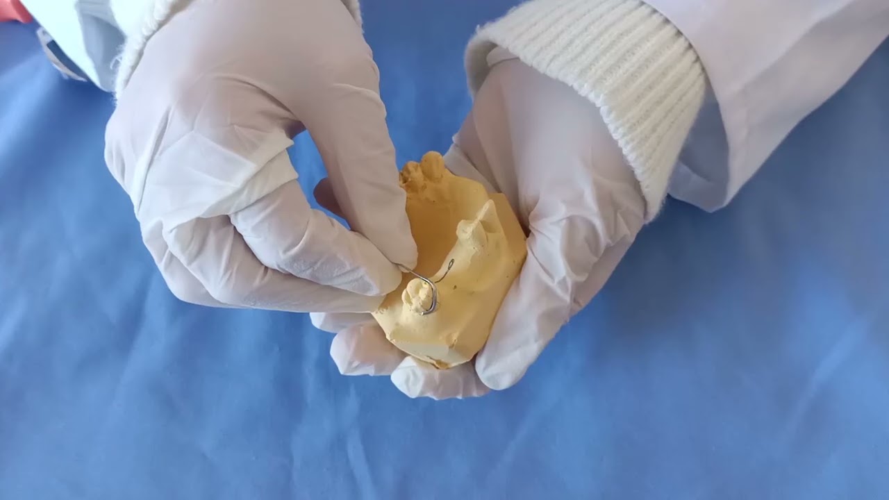 Façonnage d'un crochet sur la molaire