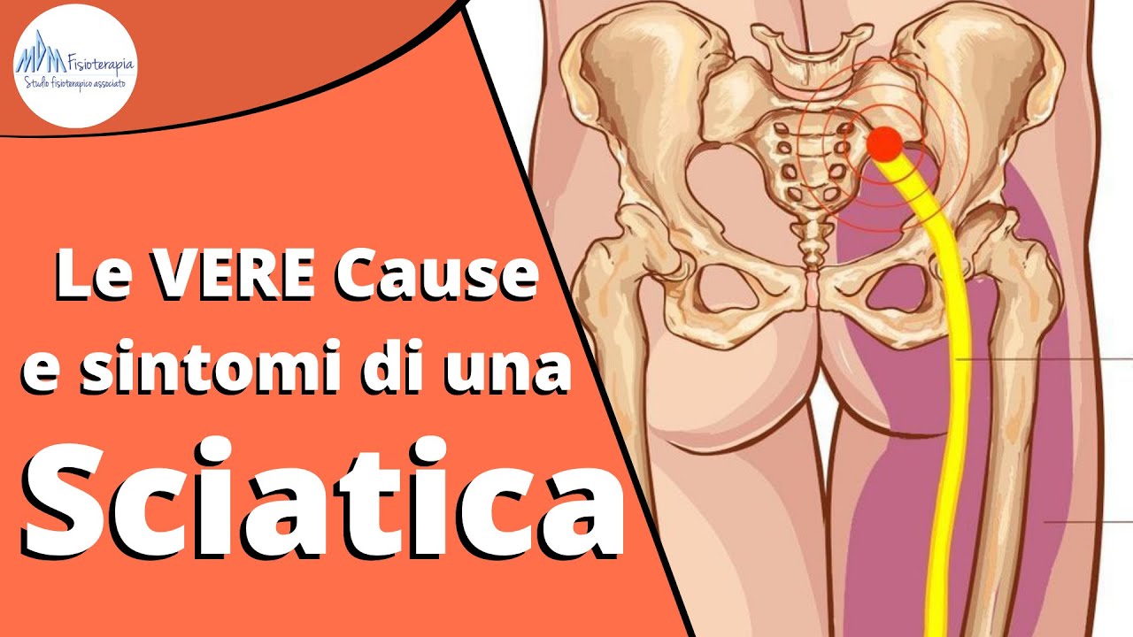 Le VERE Cause e Sintomi di una Sciatica e come combatterli DEFINITIVAMENTE