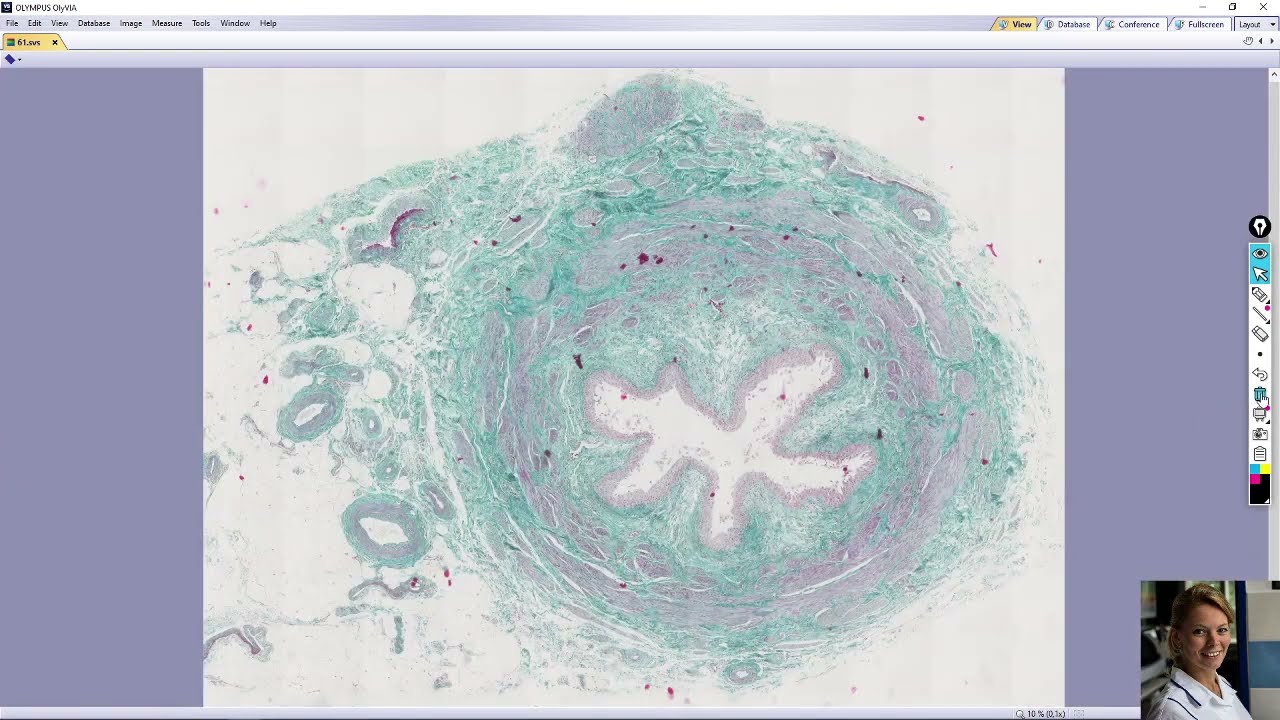 močovod (ureter)
