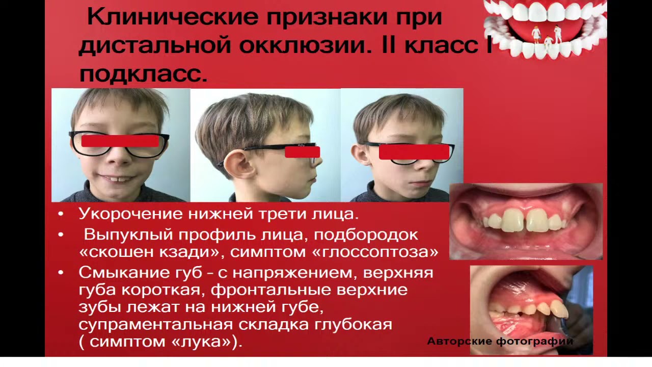 13:50  Аномалии окклюзии