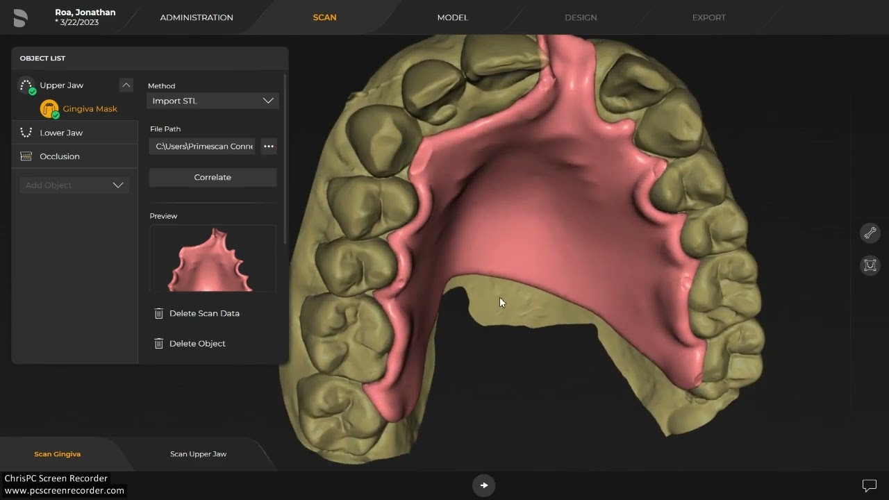 Single Tooth Flipper using Inlab