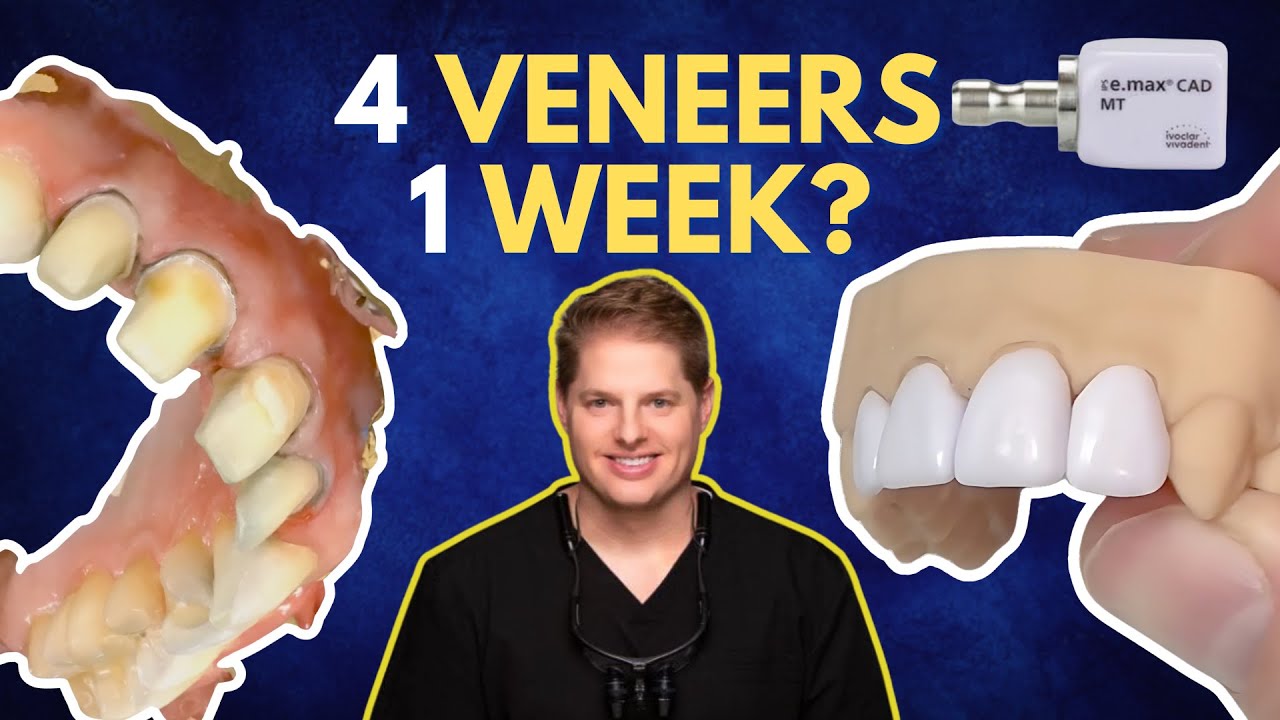 Restoring a Smile with In-House Digital Veneers | Case Bites