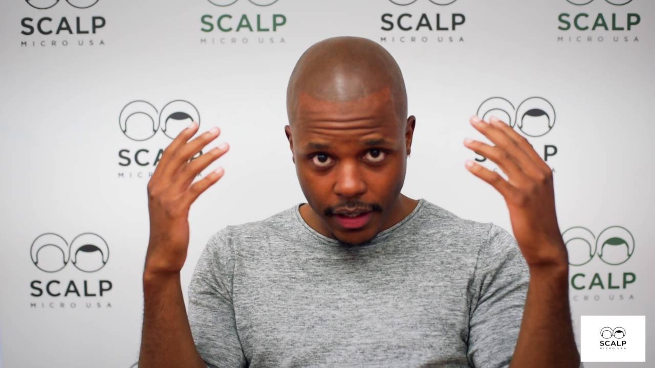Real Scalp Micropigmentation Testimonial - Scalp Micro USA